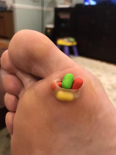 a punctured blister on the balls of the feet in which a couple of tic tacs have been put